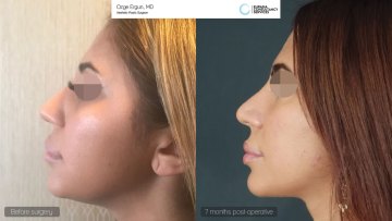 rhinoplasty