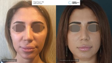 rhinoplasty