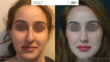 rhinoplasty