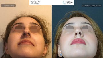 rhinoplasty