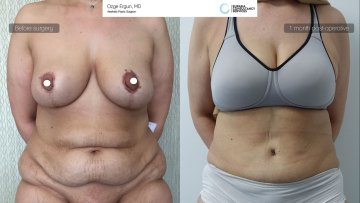 be_af_mam_tummytuck_1