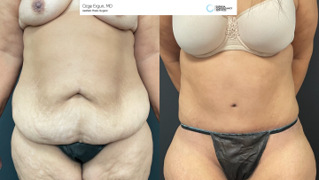 be_af_tummytuck_1_64766157