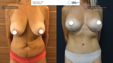 ba_af_mrs_breastlift_tummytuck1