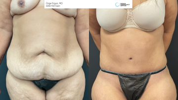 be_af_tummytuck_1_64766157