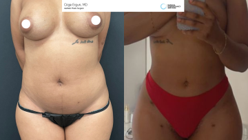 be_af_fullwasitlipo_70837734