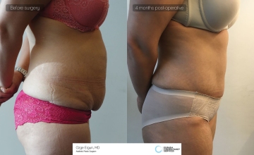be_af_mdg_tummytuck3