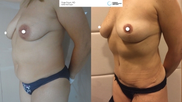 be_af_tummy_nd3