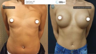 ba_af_dast_breast_augmentation1