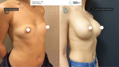 ba_af_dast_breast_augmentation2