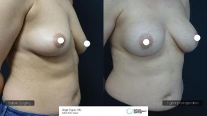 ba_af_emsn_breast_implant3