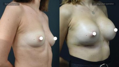 ba_af_sbr_breast_augmentation3