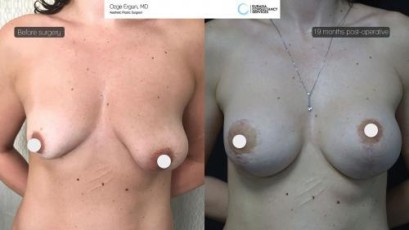 ba_afdrbh_breastlift_implant1