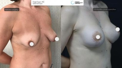 ba_afdrbh_breastlift_implant2