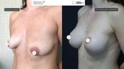 ba_afdrbh_breastlift_implant3