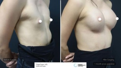ba_mlk_breast_implant1