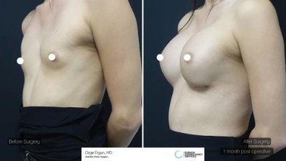 ba_mlk_breast_implant2