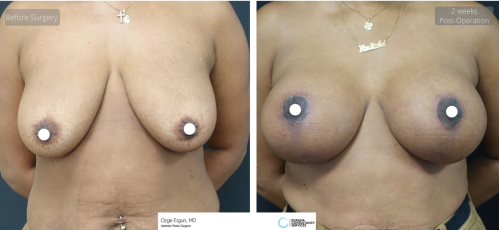 be_af_ardg_breast_surgery_1