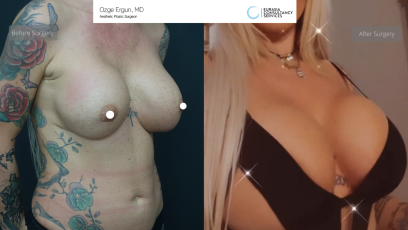 be_af_dlp_breast_surgery