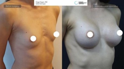 breast-implant-02
