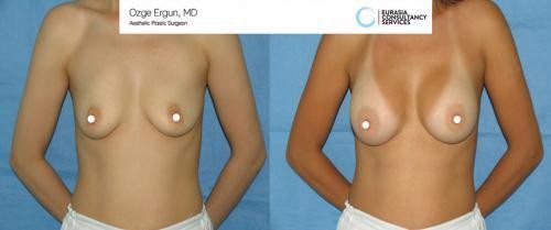 breast_implant_OE_1_1