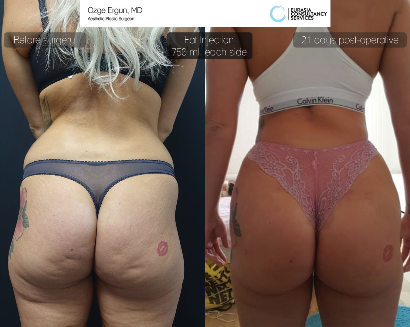 Brazilian Butt Lift - Plastic Surgery Before and After Photos